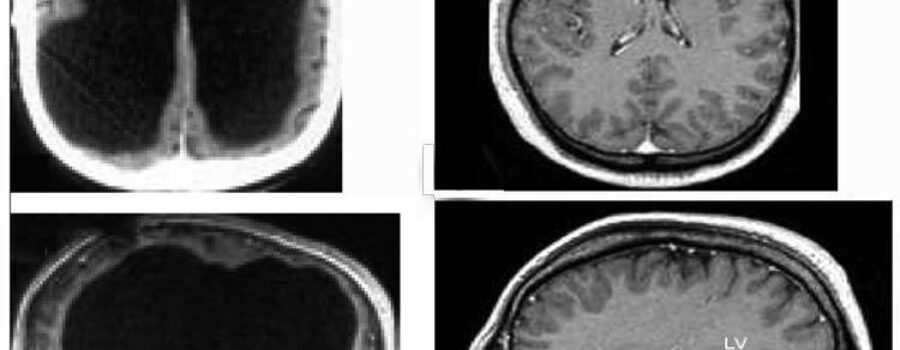 한 남성 뇌의 90%가 손상 됨 - The Lancet, Feuillet et al
